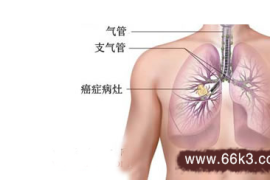 居然可以这样（治肺病最有效的药有哪些）肺结核用什么中药可以治好，治肺癌的偏方，