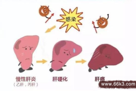 燃爆了（治疗晚期肝癌的偏方秘方）肝癌晚期最好的医治方法，肝癌的早期症状及前兆-特效民间肝癌偏方，