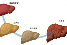 难以置信（脂肪肝食疗食谱）脂肪肝的饮食疗法，治疗脂肪肝六个食疗偏方，